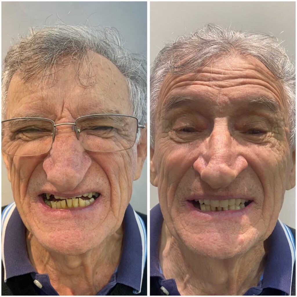 Prótese Protocolo Antes e Depois