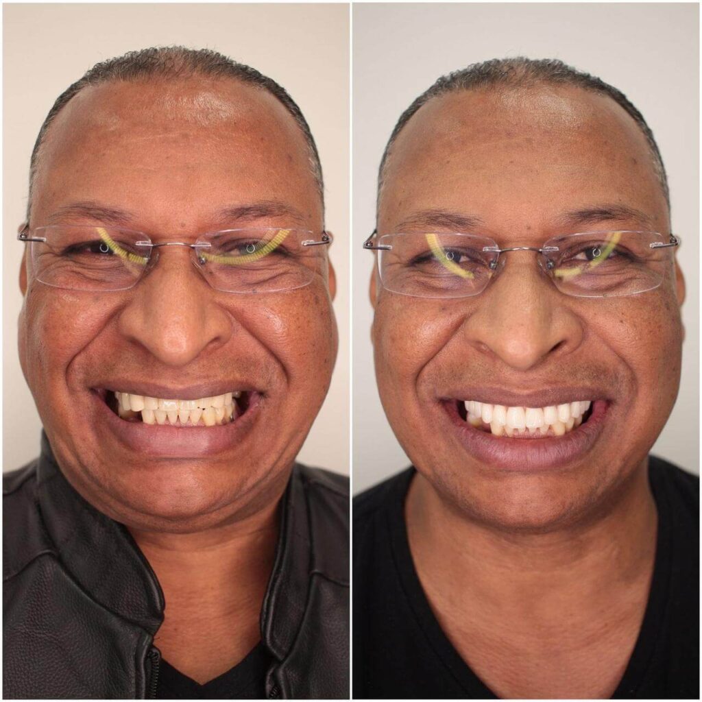 Prótese Protocolo Antes e Depois