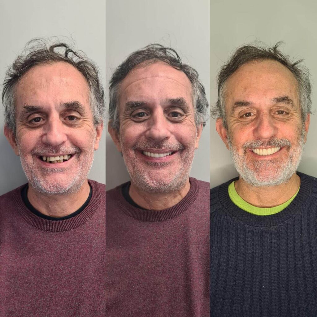 Prótese Protocolo Antes e Depois