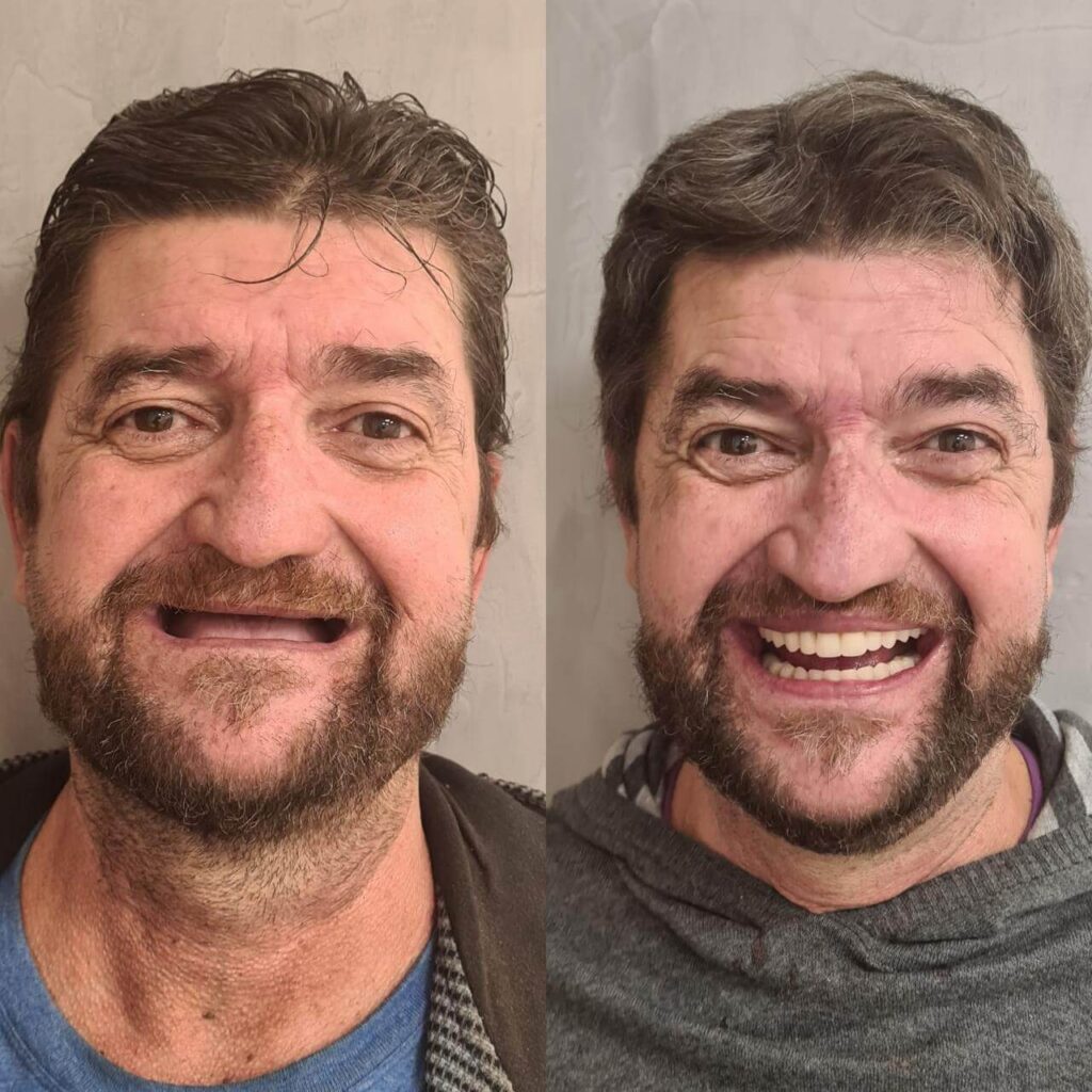 Prótese Protocolo Antes e Depois