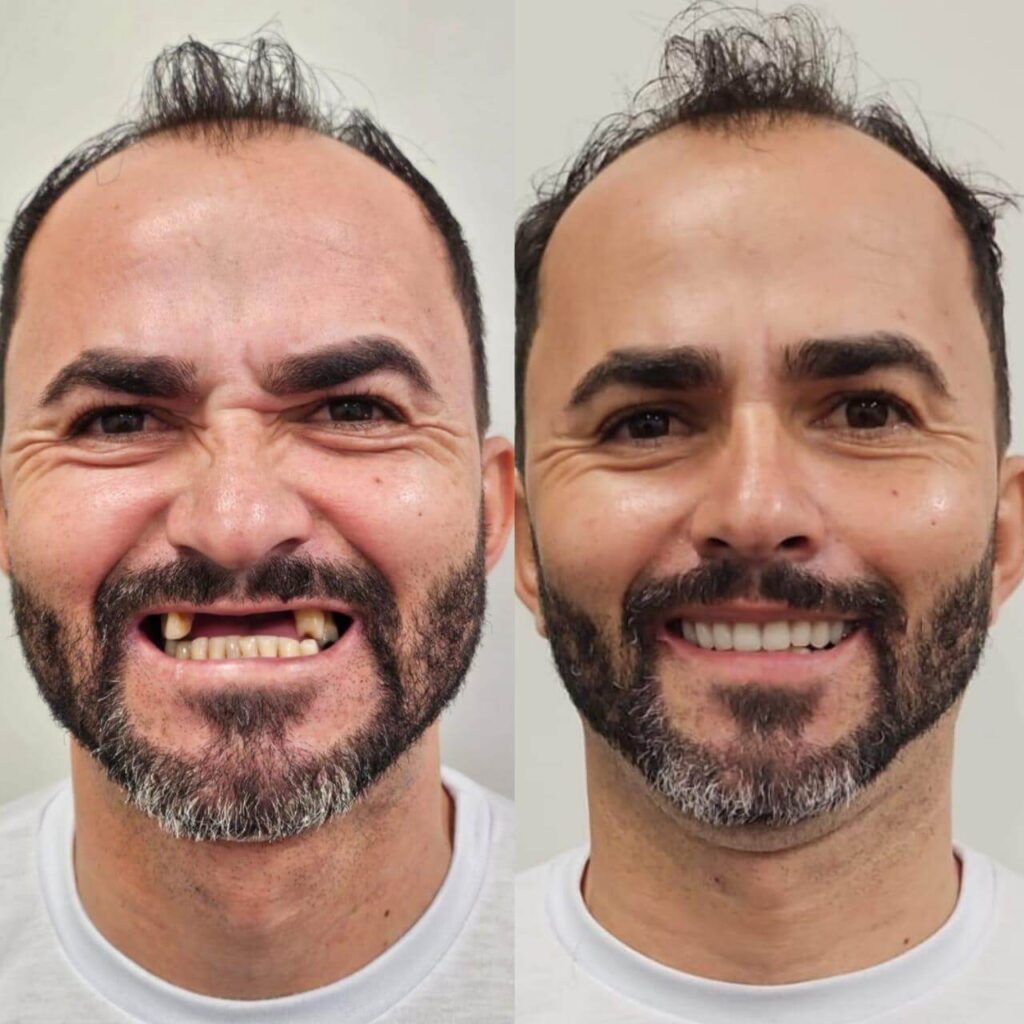 Prótese Protocolo Antes e Depois