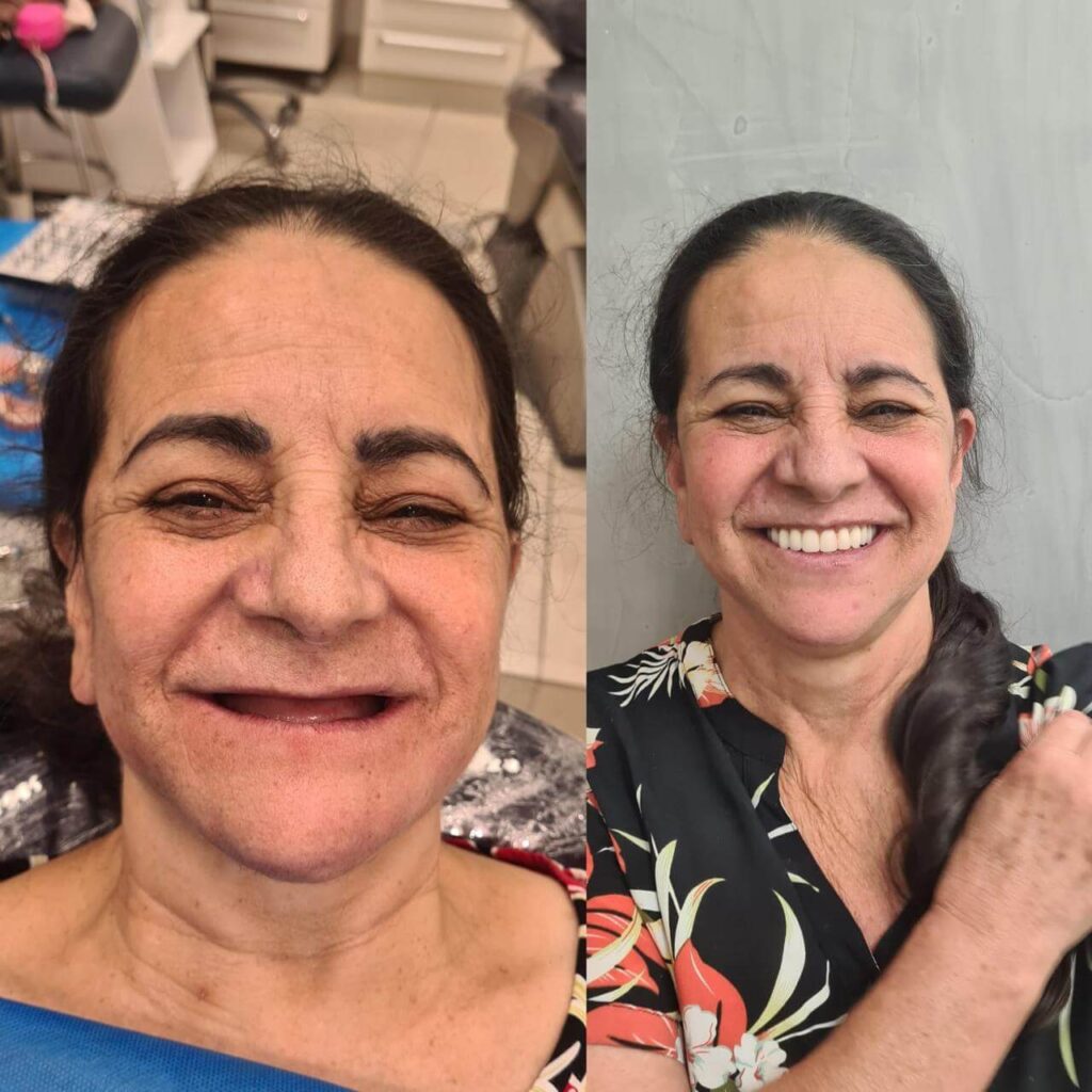 Prótese Protocolo Antes e Depois