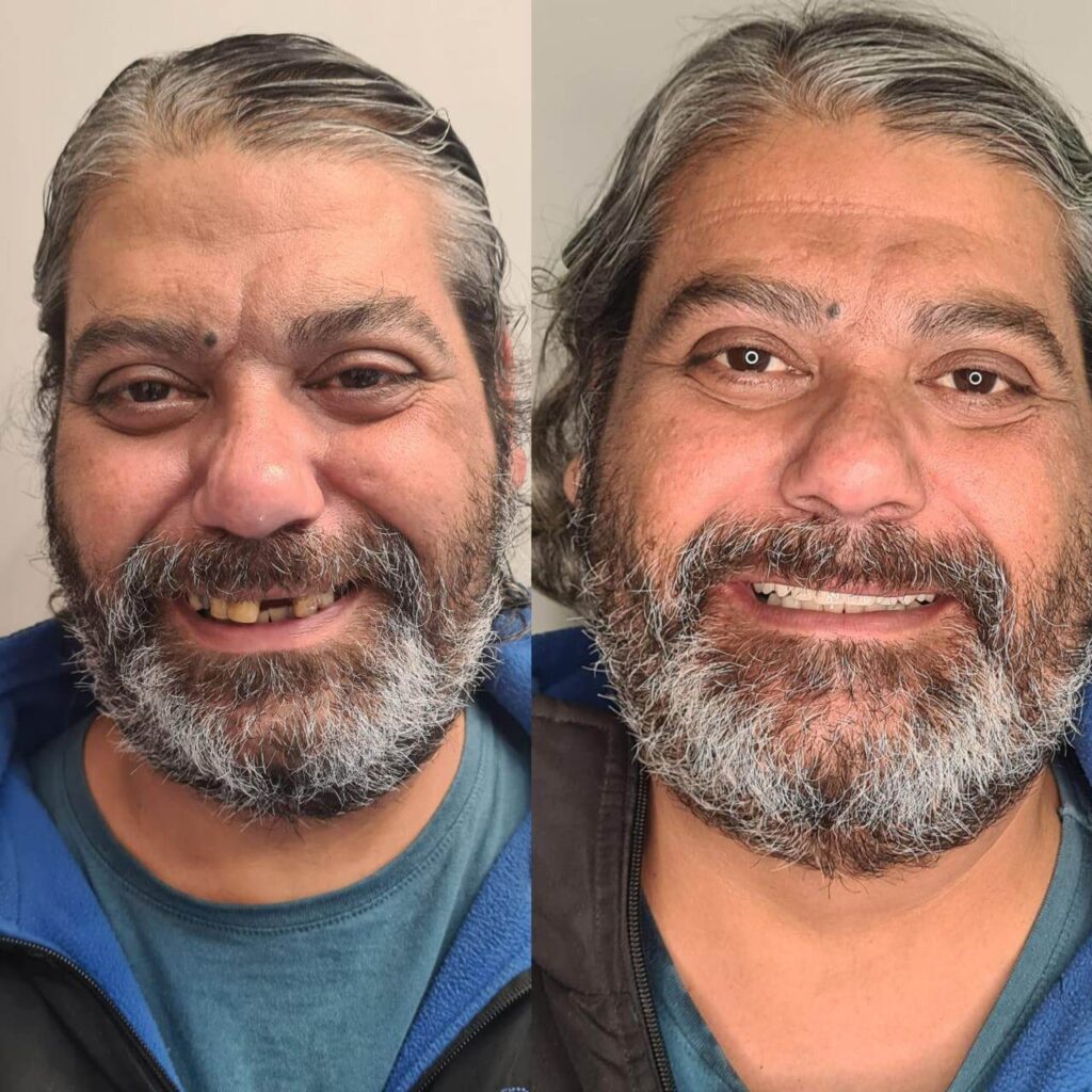 Prótese Protocolo Antes e Depois