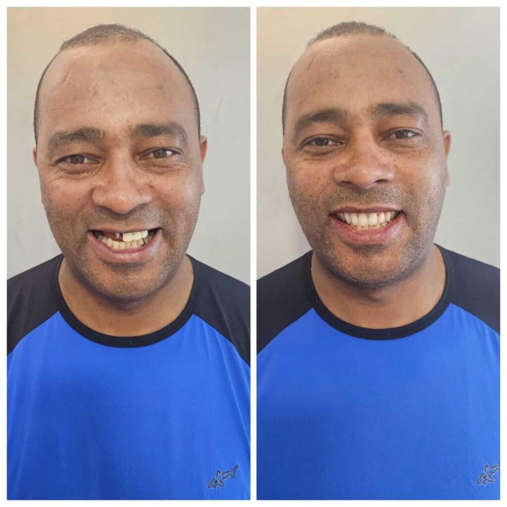 Prótese Protocolo Antes e Depois