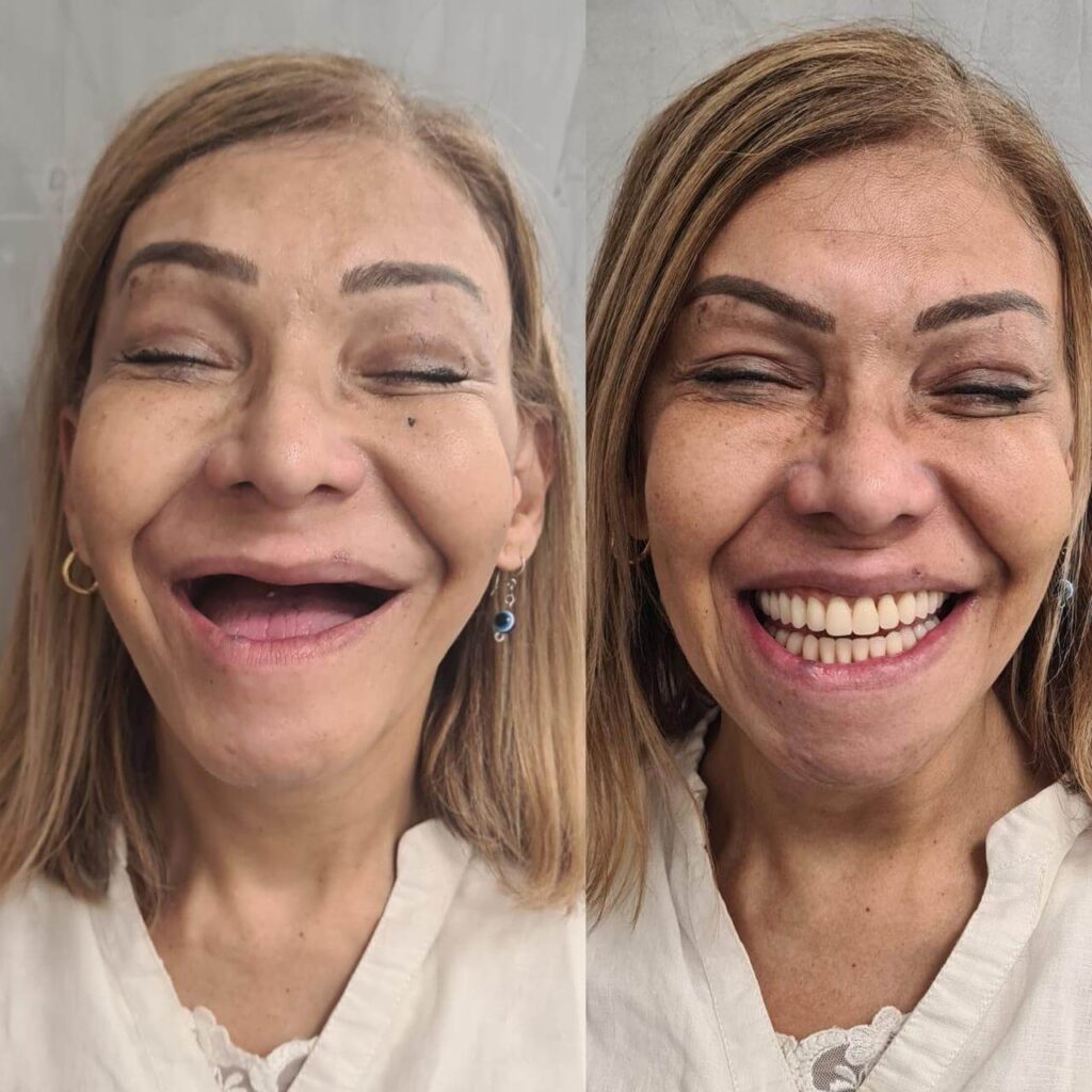 Prótese Protocolo Antes e Depois