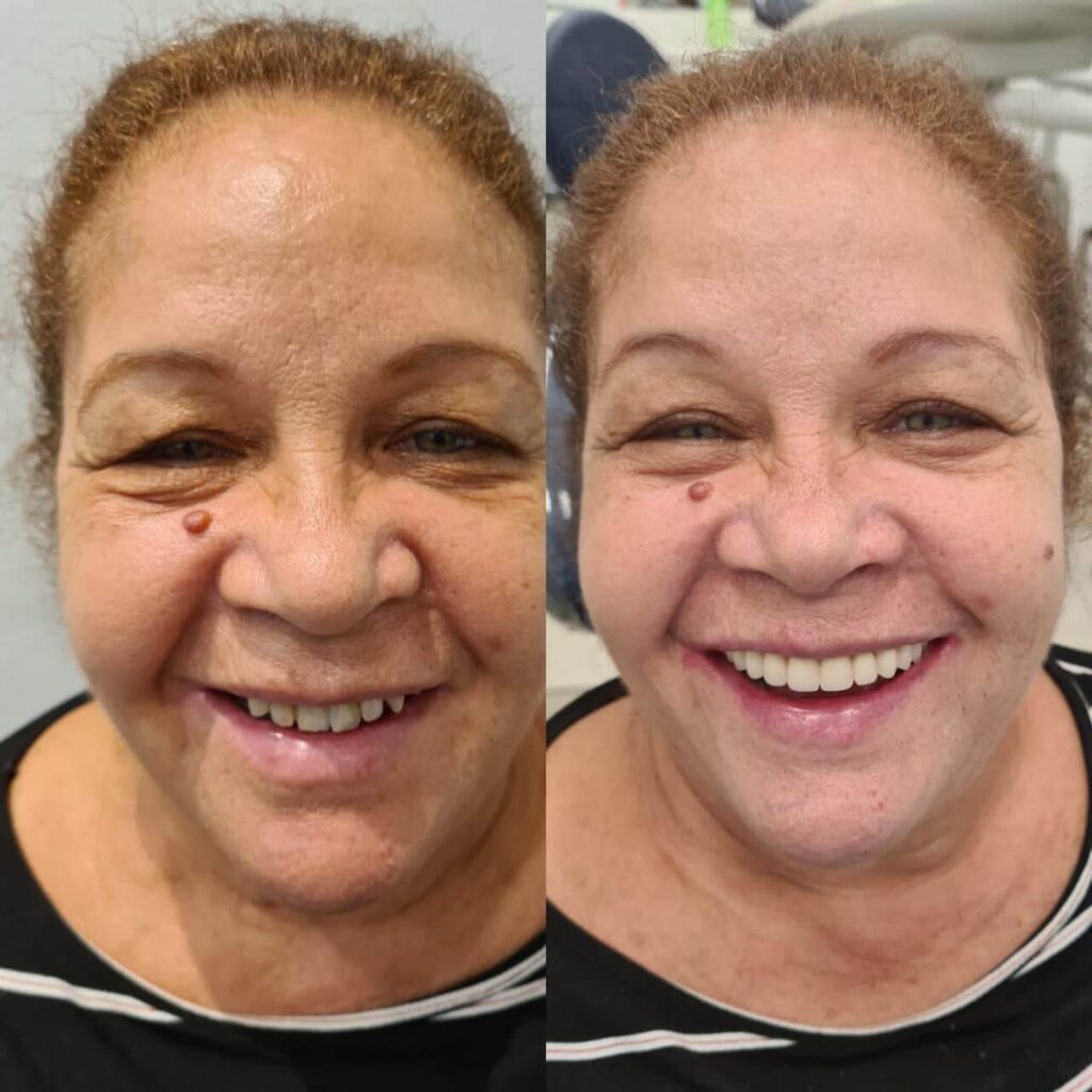 Prótese Protocolo Antes e Depois